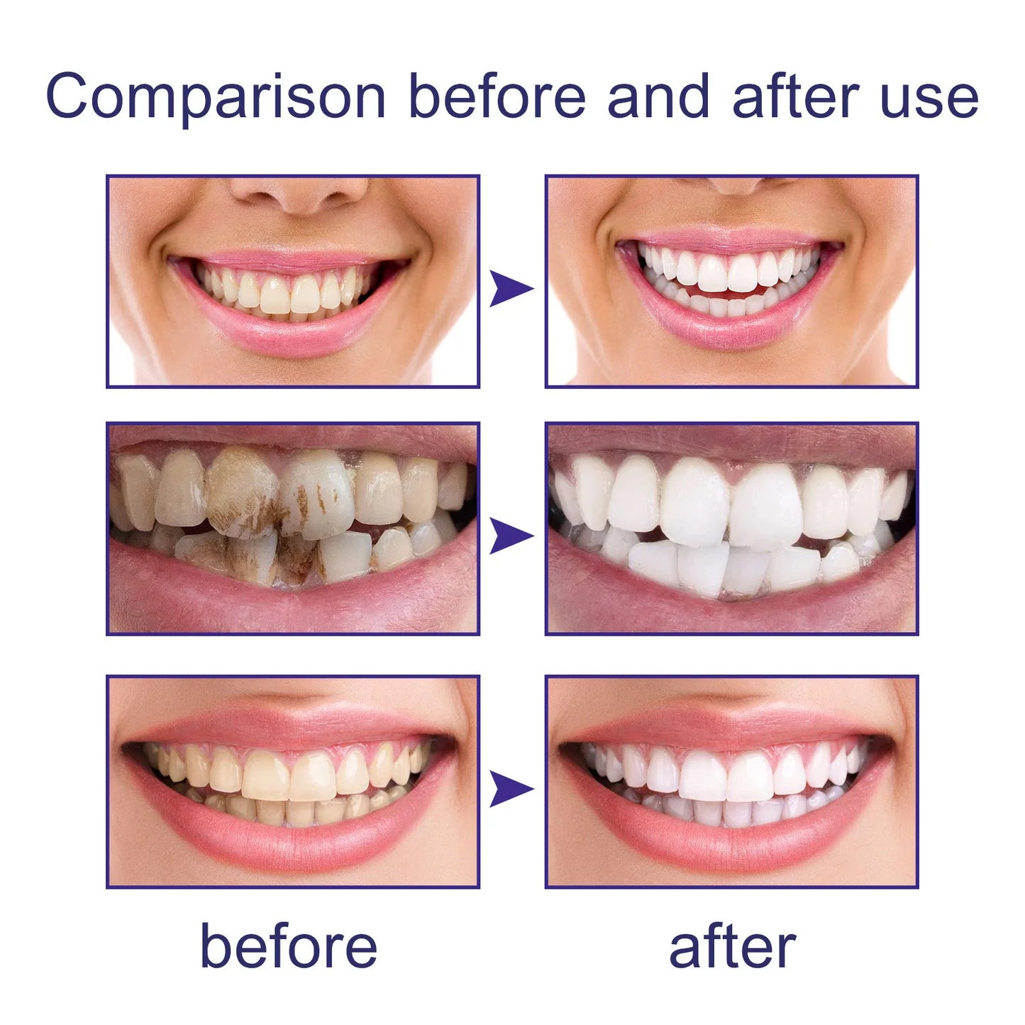 "Free Shipping" Hismile V34 Purple Toothpaste – Remove Yellow Stains & Brighten Your Smile